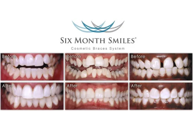 Six Month Smiles Clear Aligners in Milford