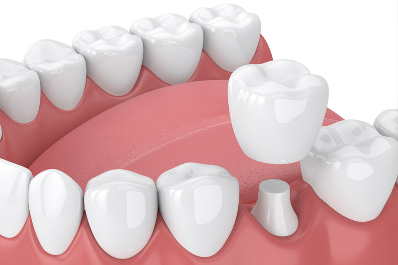 Dental Crowns in