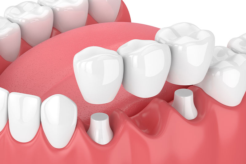 Dental Bridges in
