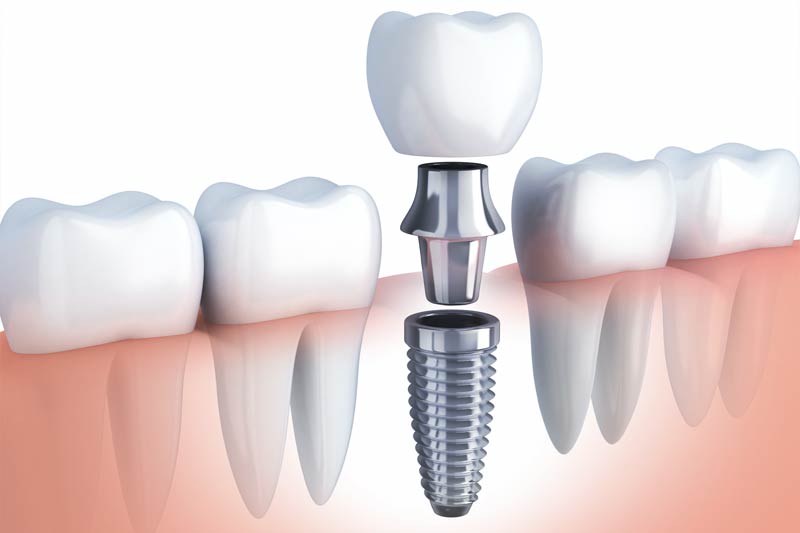 Dental Implants in Milford