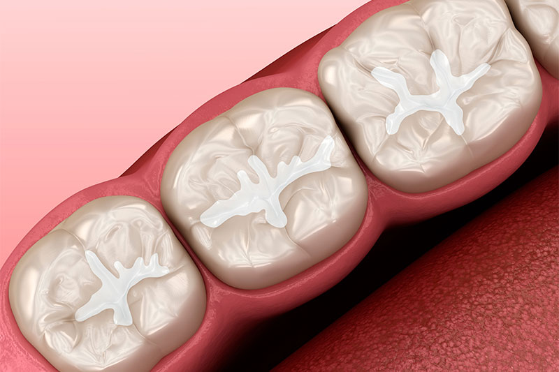 Dental Bonding in