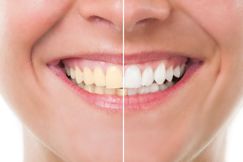 Teeth Whitening  in Milford