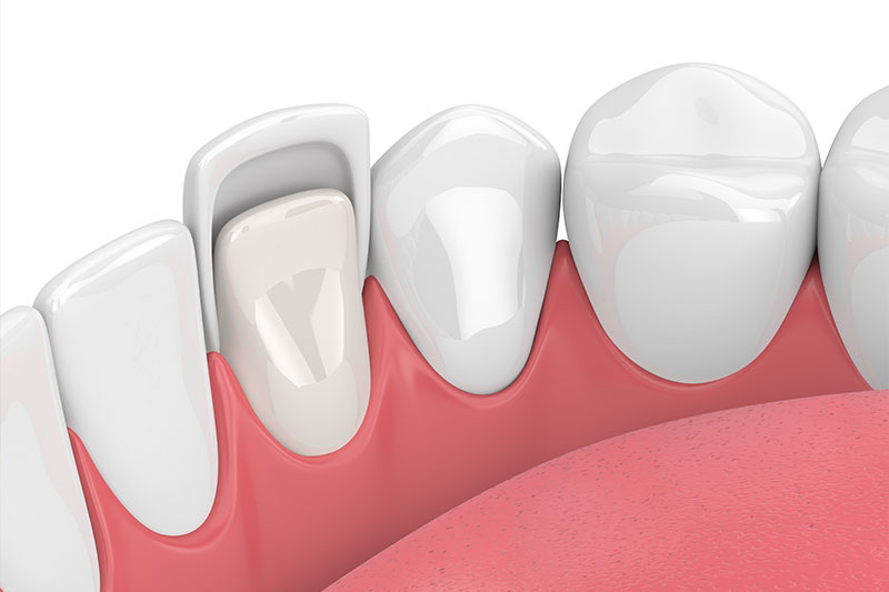 Dental Veneers in